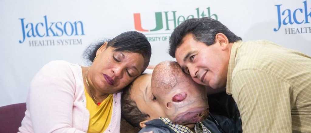 Murió Emanuel, el nene cubano con un gigantesco tumor en la cara 