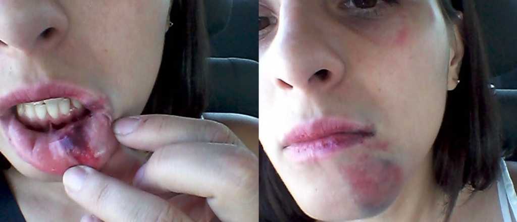 Una joven de Guaymallén denunció que recibió una paliza por no dejarse besar