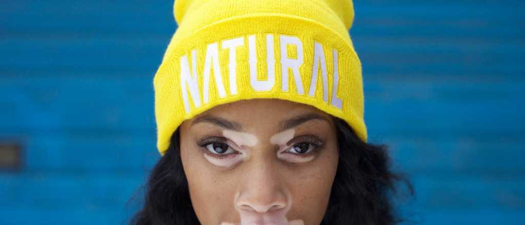 Winnie Harlow, la modelo que subió el vitiligo a la pasarela