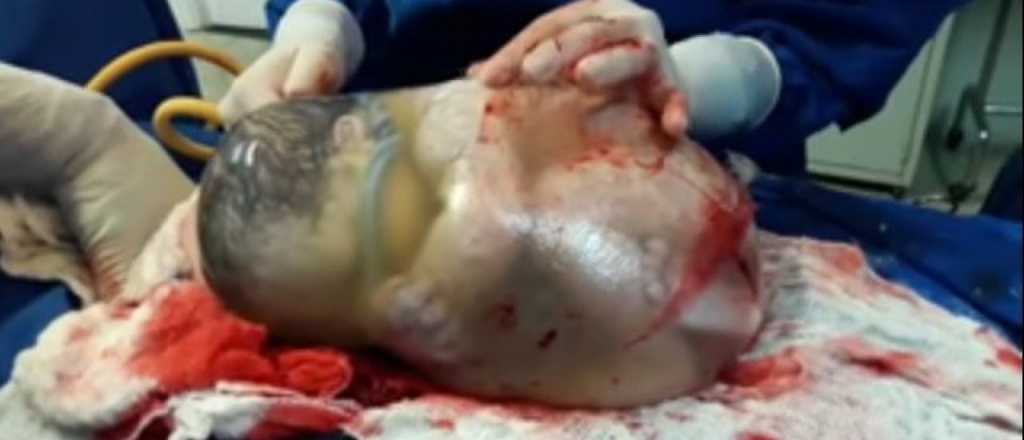 Video: el bebé que nació adentro de la bolsa