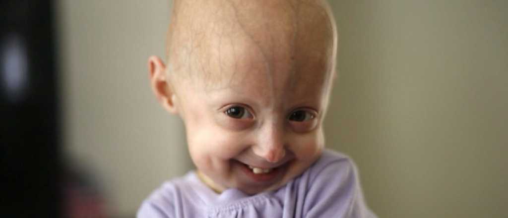 Progeria, la enfermedad que envejece a los ni&ntilde;os