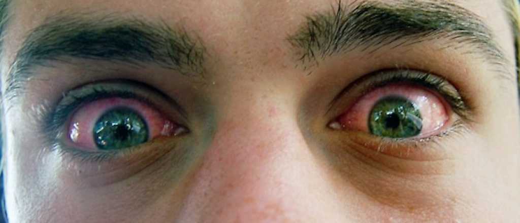 Las causas por las cuales tenemos los ojos rojos 