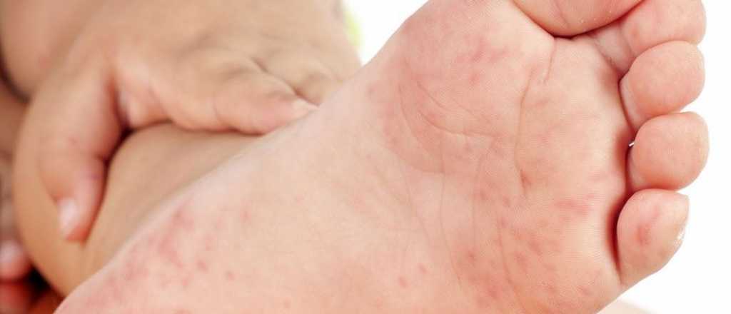 Detectaron un nuevo caso de Sarampi&oacute;n en el pa&iacute;s