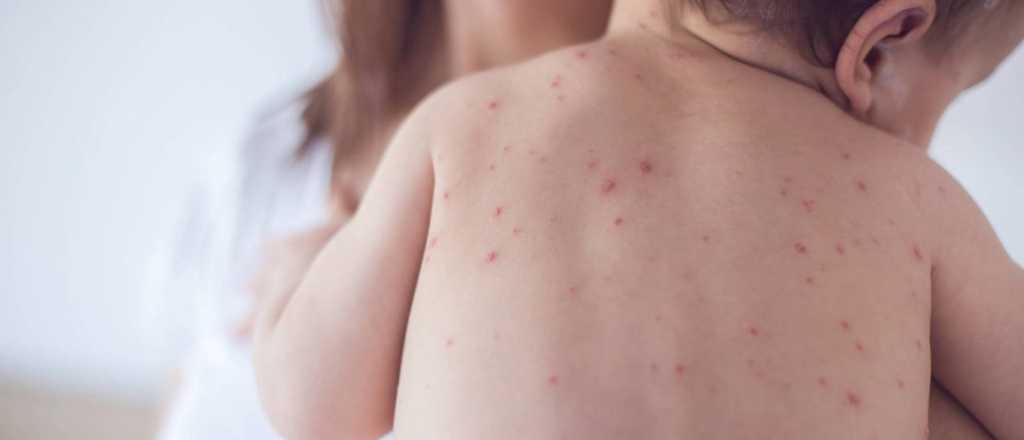 Confirman nuevos casos de sarampión en tres niñas no vacunadas 