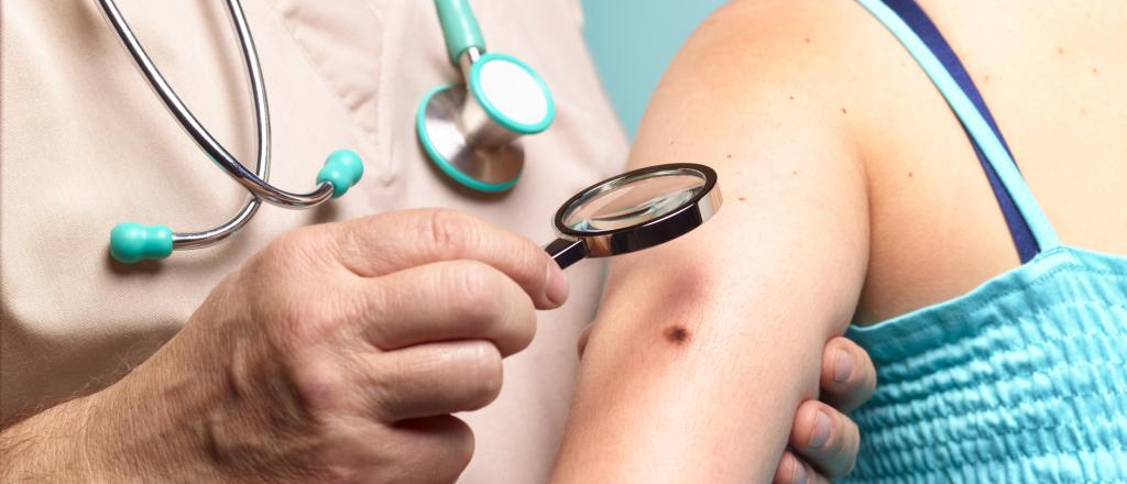 Científicos probaron con éxito una vacuna contra el cáncer de piel