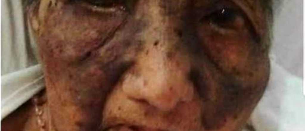 Indignante: golpearon y quemaron a una abuela de 93 años durante un robo