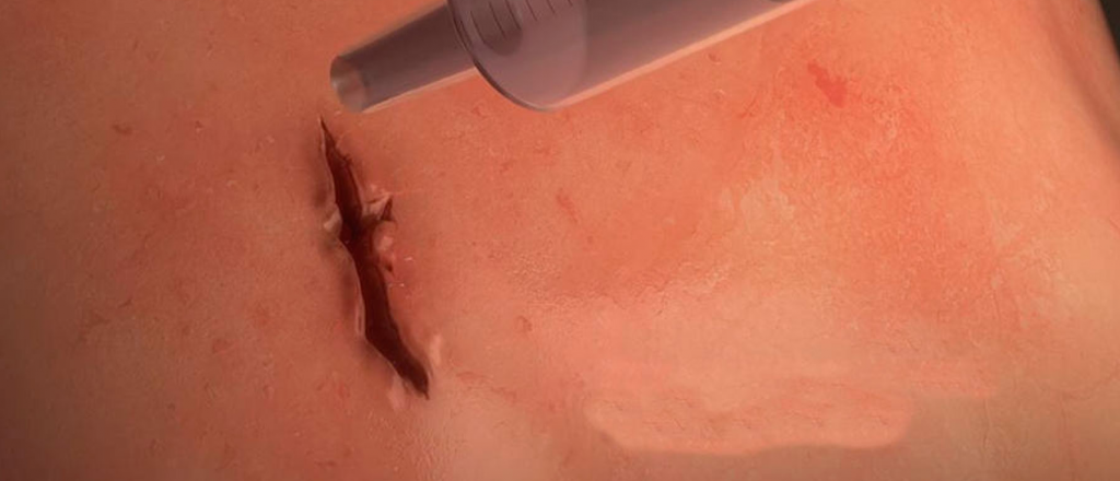 Crearon un pegamento médico para cerrar heridas