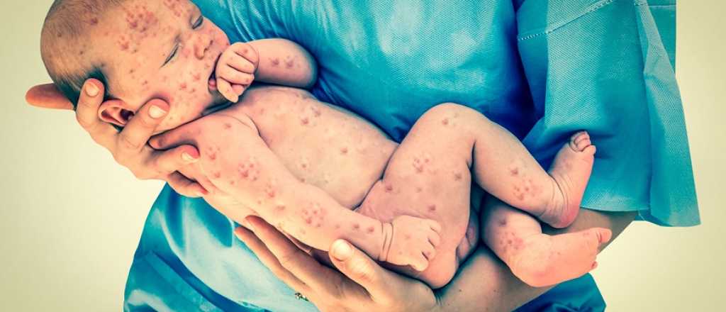 Atención: la epidemia de sarampión se desata ahora en Filipinas y piden a padres que vacunen