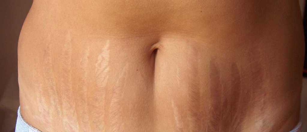 C&oacute;mo tratar en casa las estr&iacute;as rojas antes de que se vuelvan blancas 