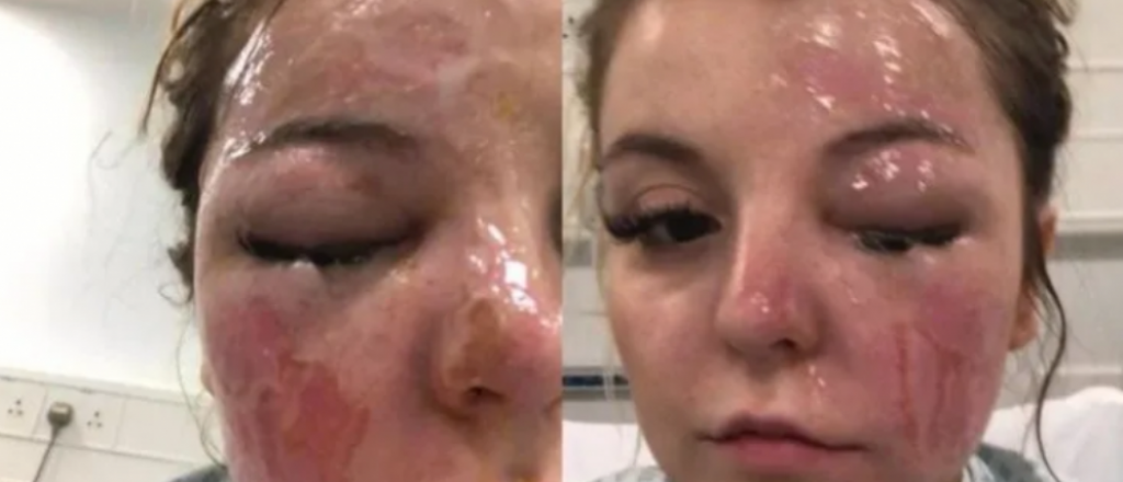 Puso a hervir dos huevos en el microondas, explotaron y qued&oacute; ciega