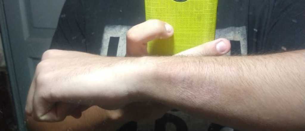 El mendocino que se hizo viral por quitarse un tattoo con un rallador