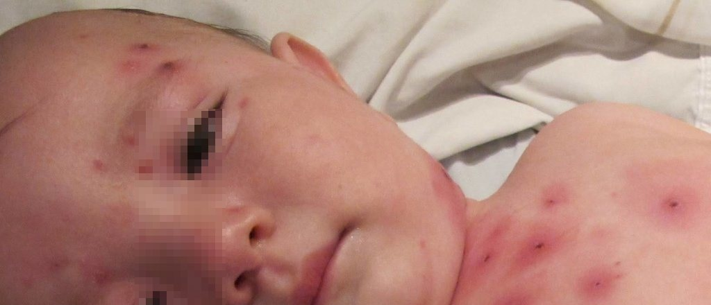 Mujer antivacunas contagi&oacute; a sus 5 hijos de sarampi&oacute;n