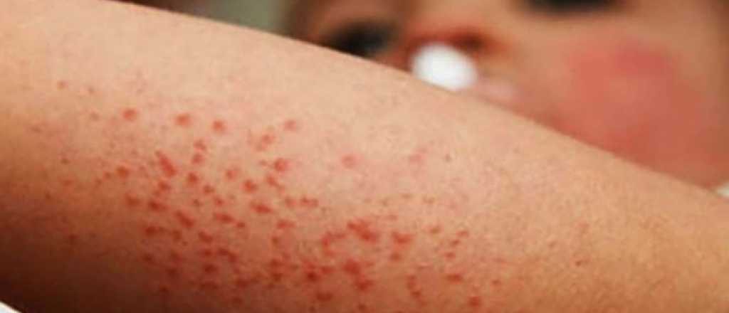 Salud emitió una alerta por riesgo de reintroducción de sarampión 