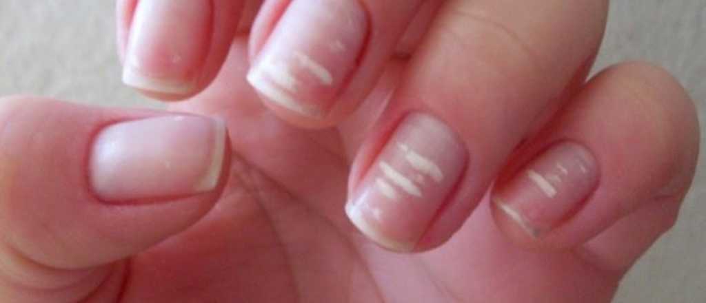 Se cae el mito de las manchitas blancas en las uñas