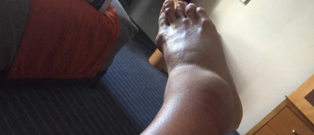 Un argentino jug&oacute; con el tobillo como el de Maradona en el 90