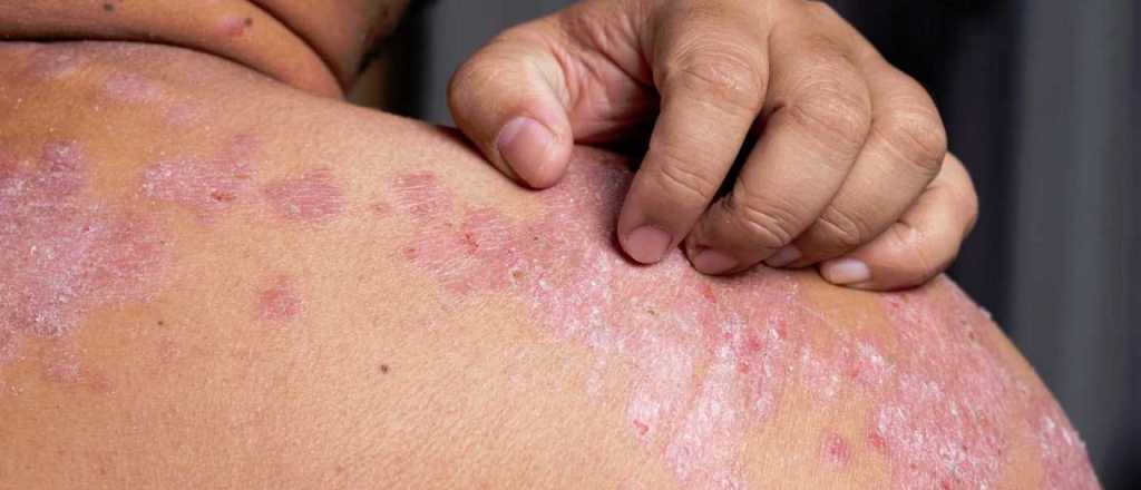 Ya est&aacute; disponible un nuevo medicamento para la psoriasis en el pa&iacute;s