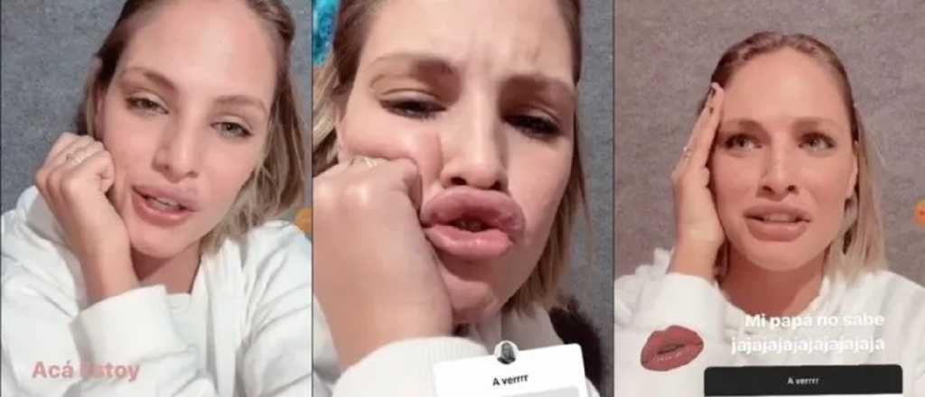 Una influencer sanjuanina se puso &aacute;cido hialur&oacute;nico en los labios y as&iacute; qued&oacute;