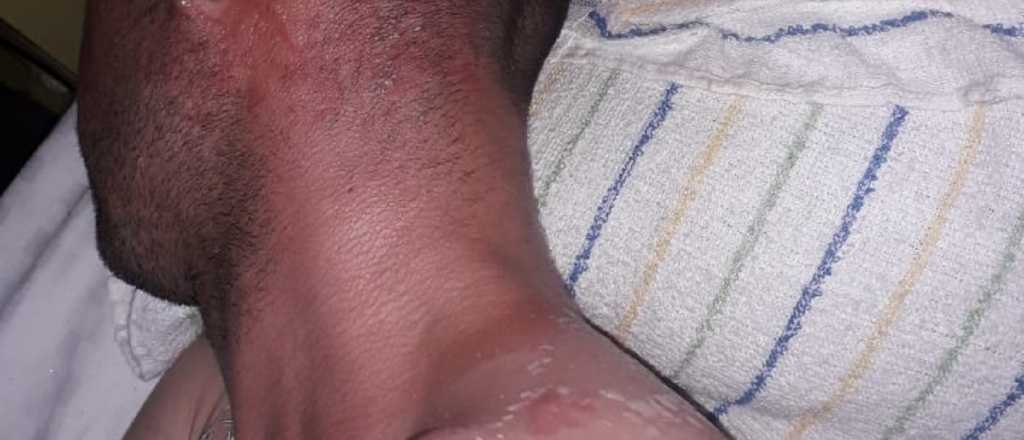 Un joven denunció que lo prendieron fuego en una comisaría de La Paz