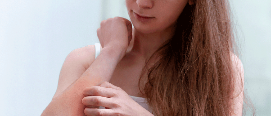 Chicos con dermatitis at&oacute;pica pierden el 15% de los d&iacute;as de clases