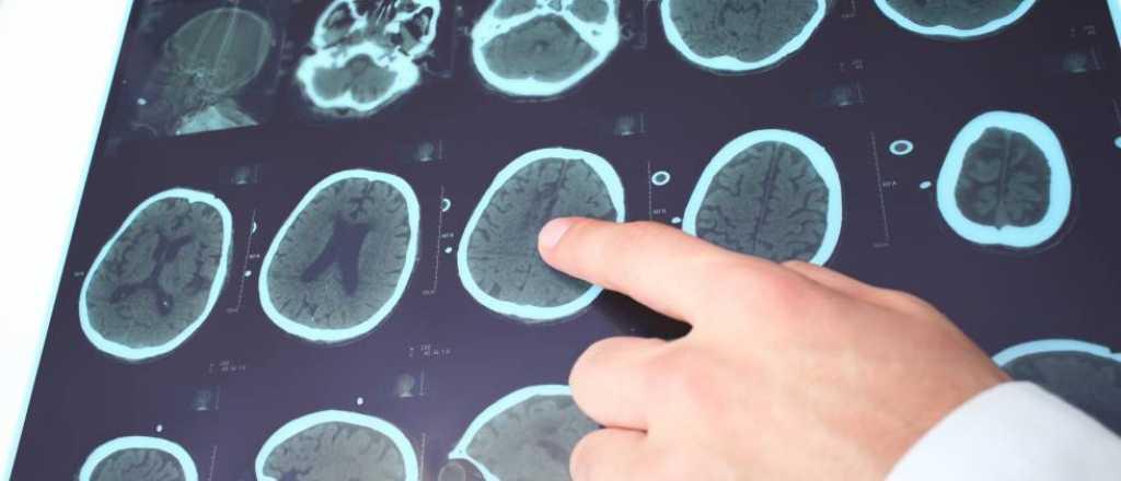 Vivir con esclerosis m&uacute;ltiple 