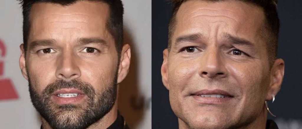 Finalmente se supo qu&eacute; le pas&oacute; a Ricky Martin en la cara