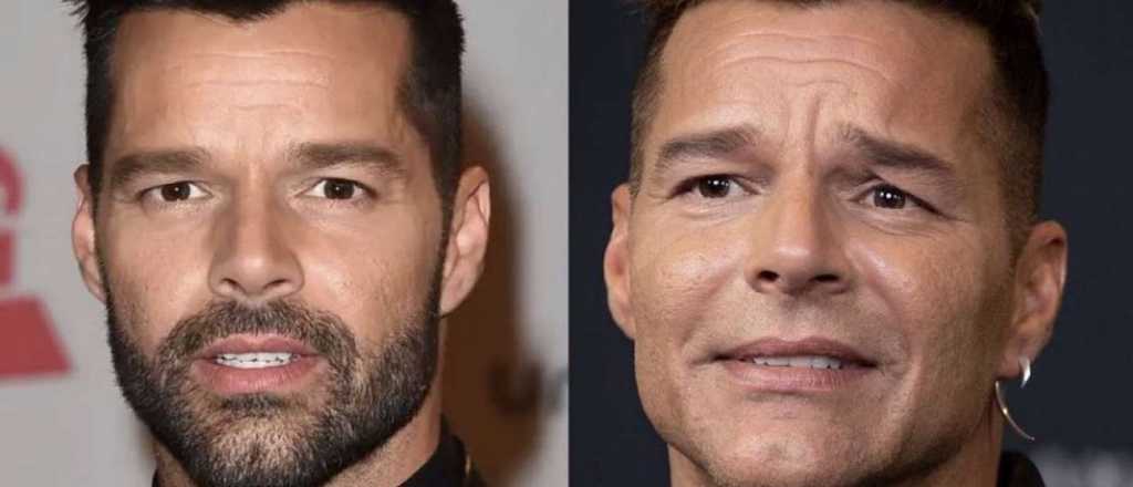 Finalmente se supo qué le pasó a Ricky Martin en la cara