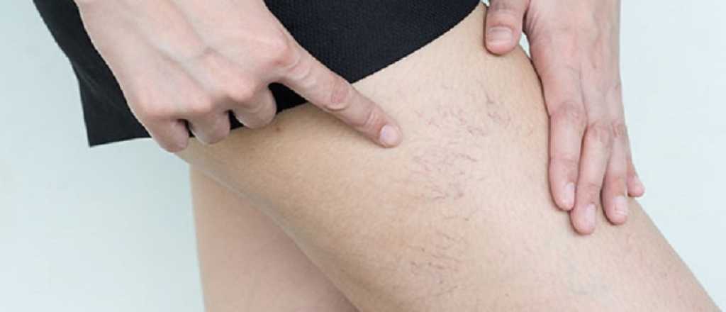 &iquest;C&oacute;mo tapar las ara&ntilde;itas vasculares?