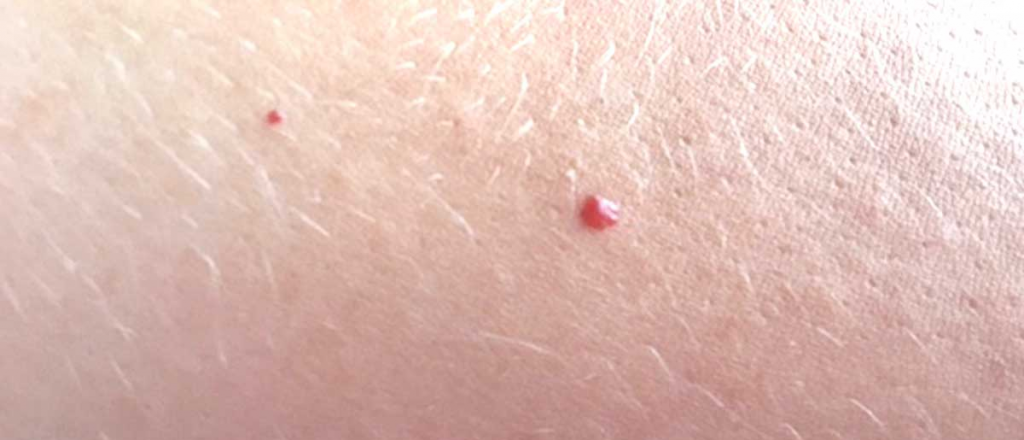 ¿Qué son esos puntos rojos que nos aparecen a veces en la piel?