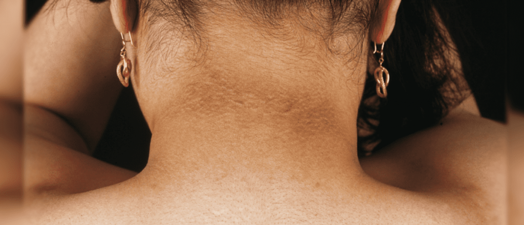 C&oacute;mo quitar las manchas oscuras del cuello, axilas o codos