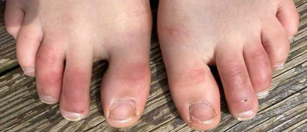 "Dedos de los pies Covid": cómo es el síntoma que provoca la cepa Ómicron