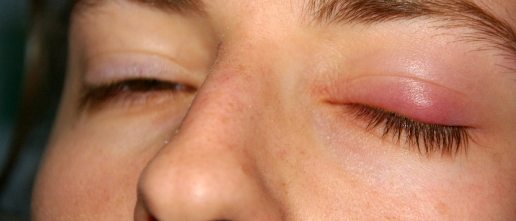 As&iacute; pod&eacute;s tratar un orzuelo con remedios caseros