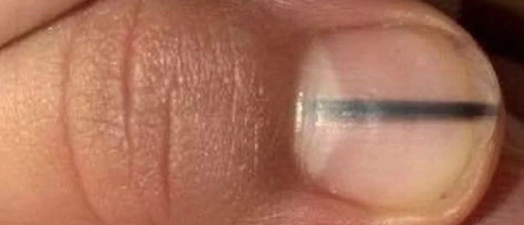 Cuidado si ten&eacute;s esta mancha negra en la u&ntilde;a