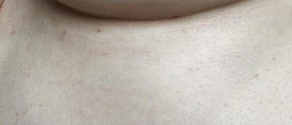 &iquest;Por qu&eacute; suelen salir granitos debajo de los pechos?