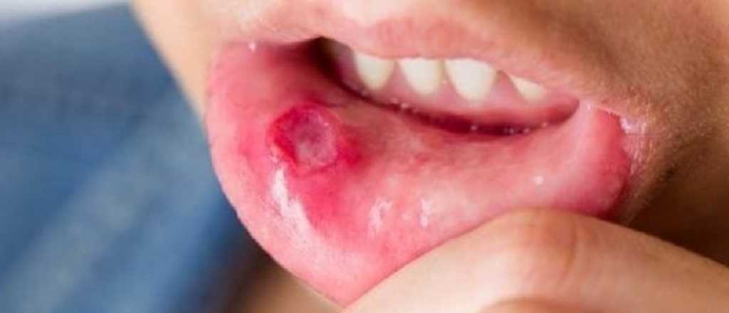 ¿Cómo curar las llagas de la boca con remedios caseros?