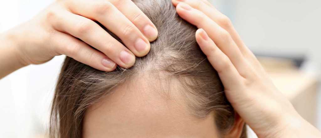Qué es la alopecia y cómo controlarla con remedios caseros