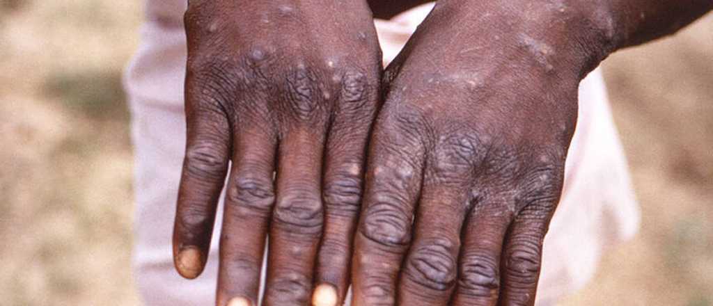 Viruela del mono: las claves para saber los s&iacute;ntomas y los riesgos