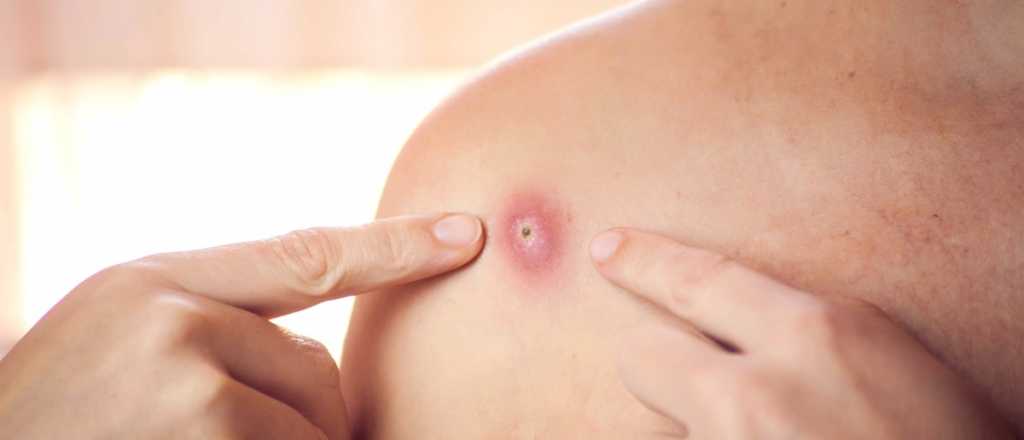 La viruela del mono se expande y ya est&aacute; en siete pa&iacute;ses