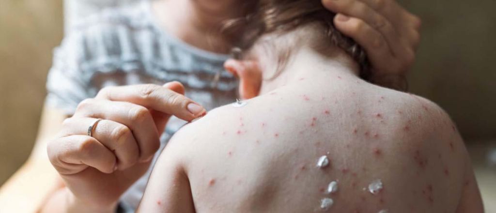 Reuni&oacute;n de emergencia de la OMS por los casos de viruela del mono en Europa