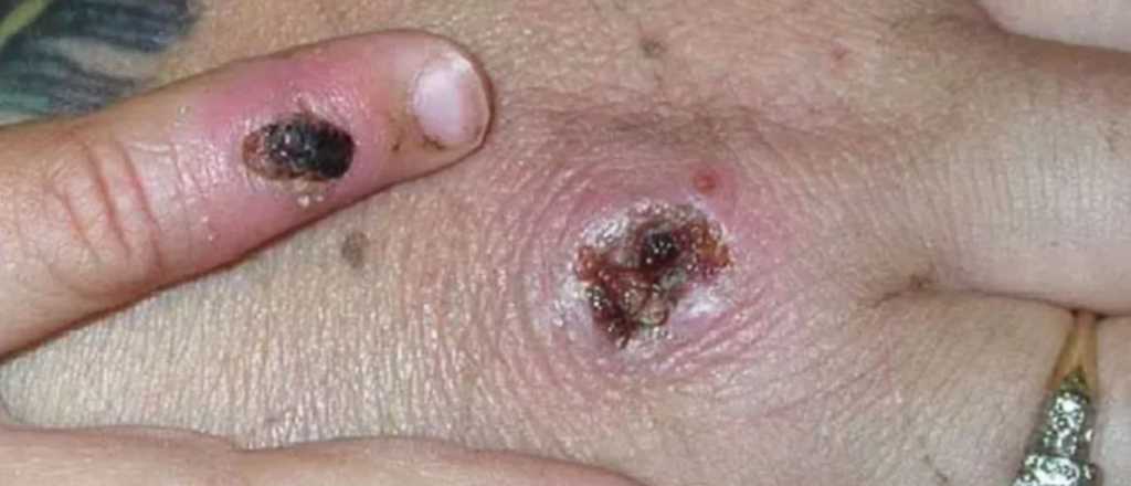 Evalúan un segundo caso sospechoso de viruela del mono en Argentina