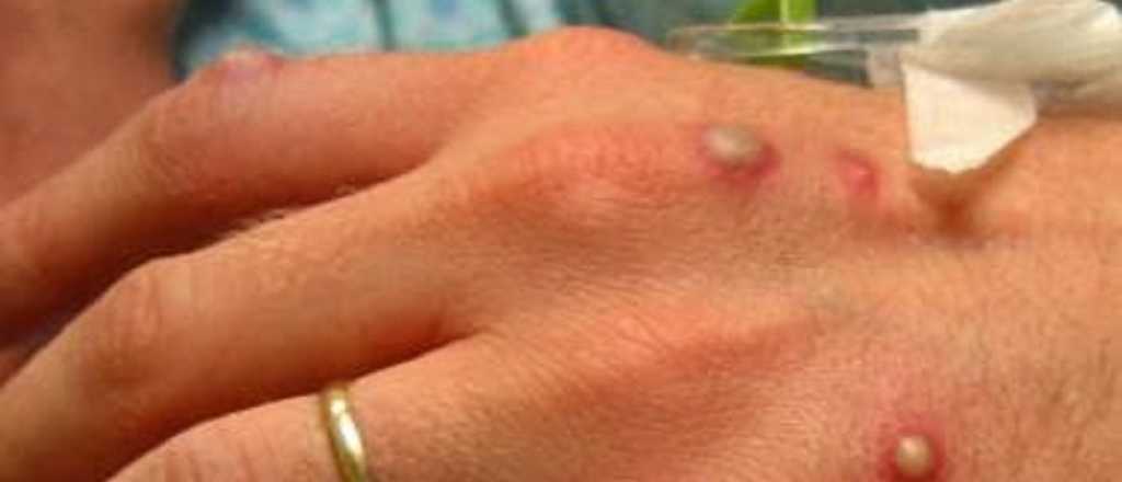 La viruela del mono ya estar&iacute;a en Argentina, seg&uacute;n un especialista