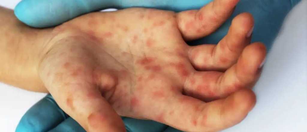 Viruela del mono: Argentina confirmó el primer caso del virus