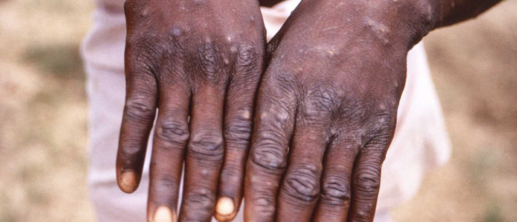 Cientificos africanos desconcertados por como se propagó enfermedad
