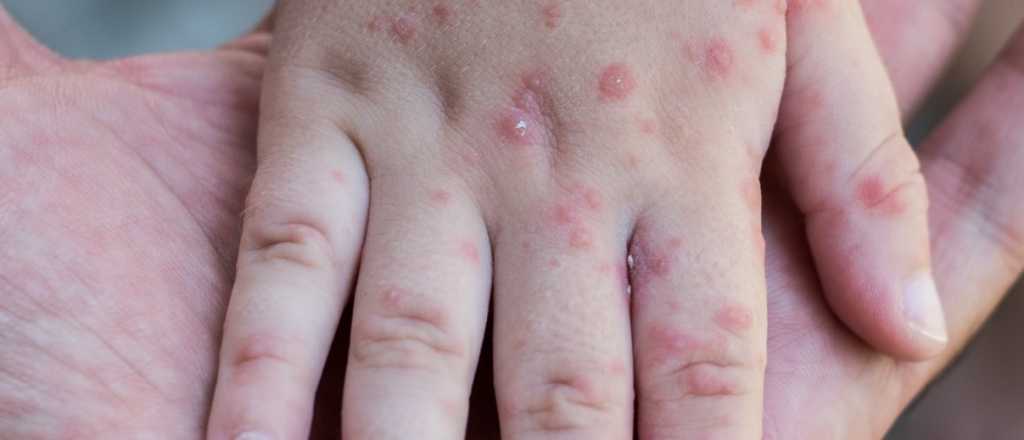 Francia confirmó 33 casos de viruela del mono