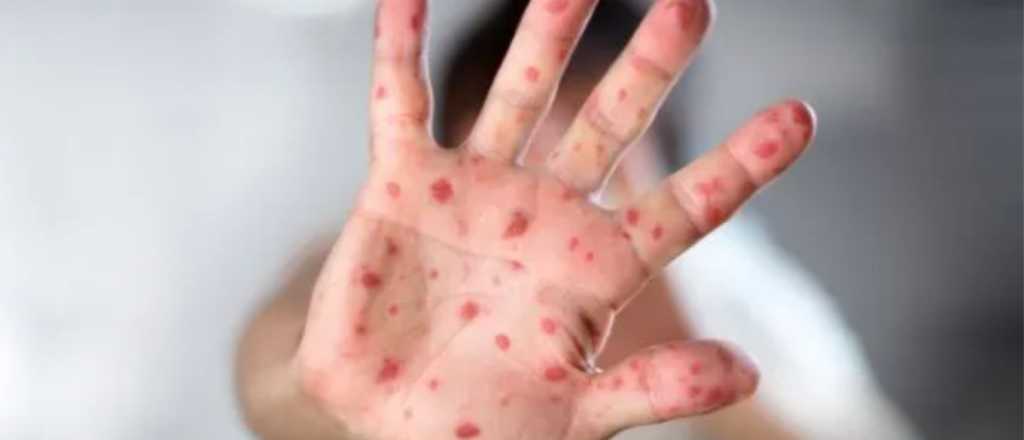 Confirman el quinto caso de viruela del mono en Argentina