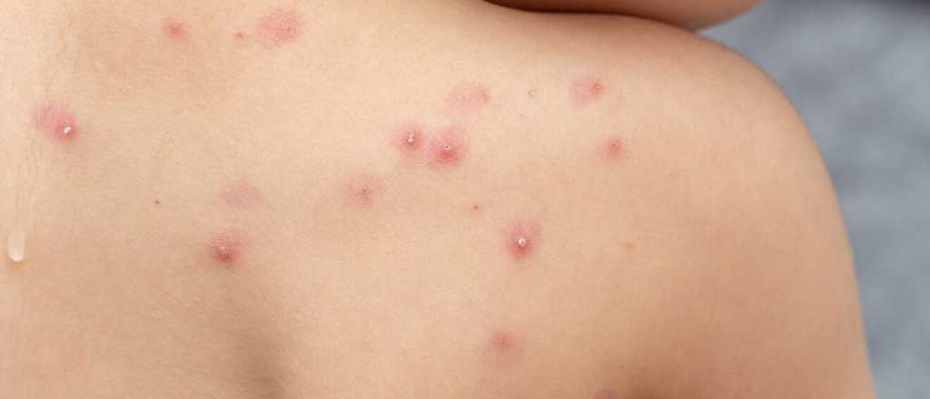 Confirmaron cinco casos de viruela del mono en Mendoza