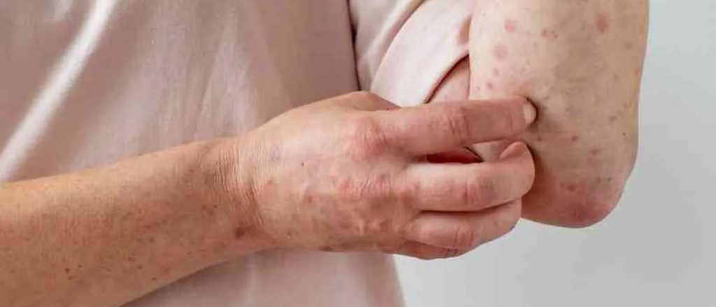 Dos alumnos en Mendoza tienen "viruela del mono": qué dijo la DGE