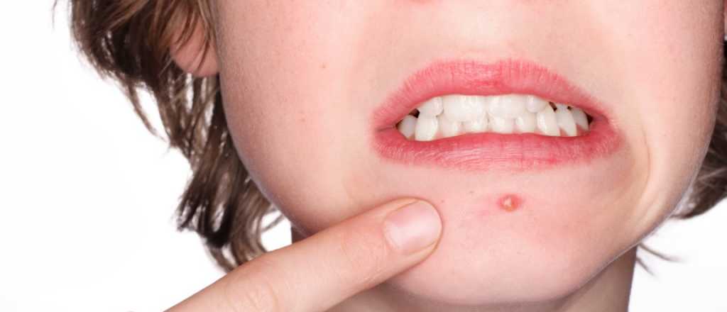 Ocho remedios caseros para combatir el acn&eacute;