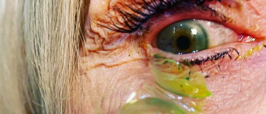 Una mujer no sabía usar los lentes de contacto y acumuló 23 en sus ojos
