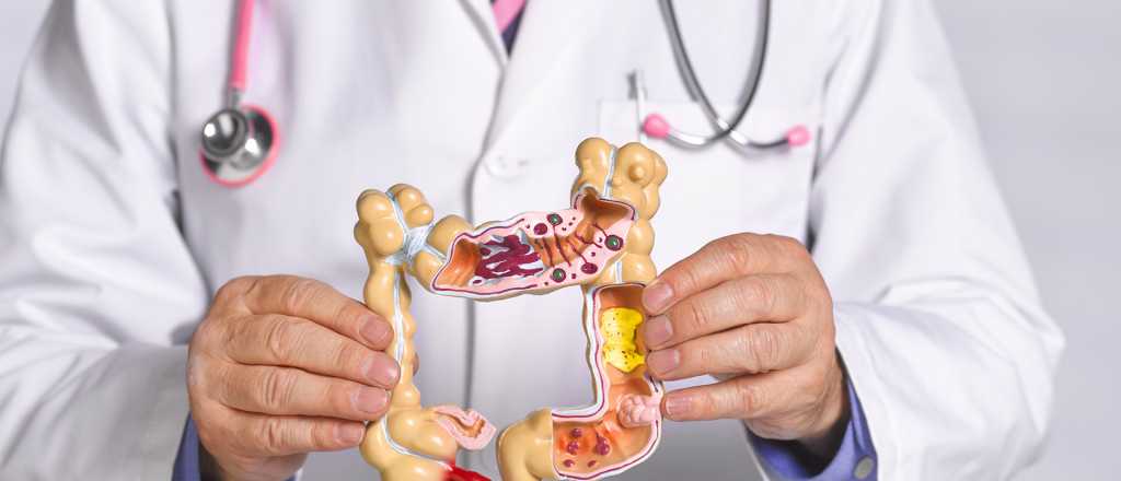 Consejos para evitar el c&aacute;ncer de colon