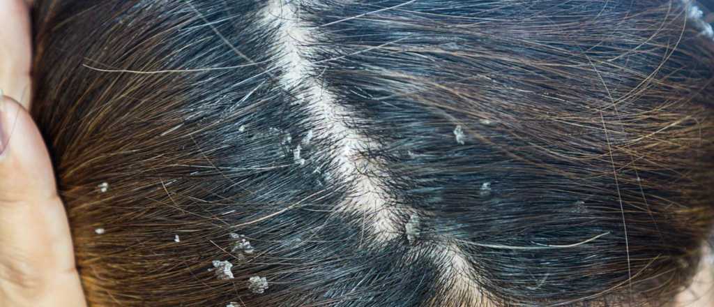 Los remedios caseros para eliminar la caspa y la picaz&oacute;n